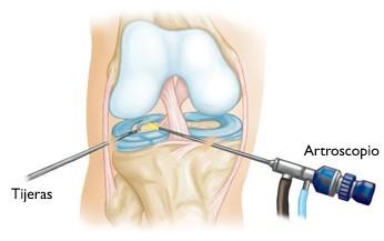 artroscopia-rodilla