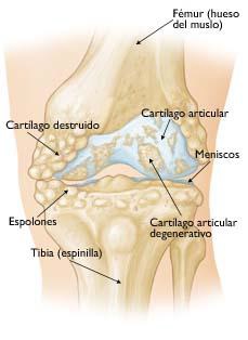artrosis-rodilla-1