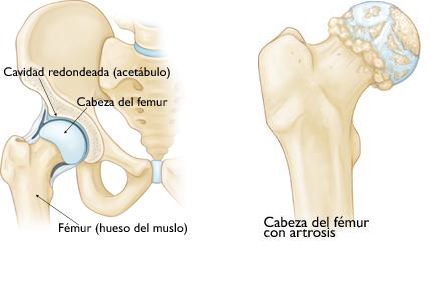 artrosis de cadera