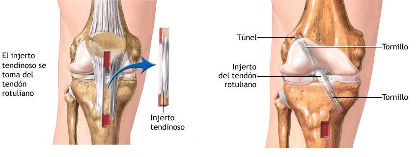 ligamento-cruzado-tendon-rotuliano