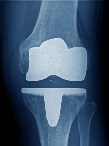 protesis-artrosis-rodilla